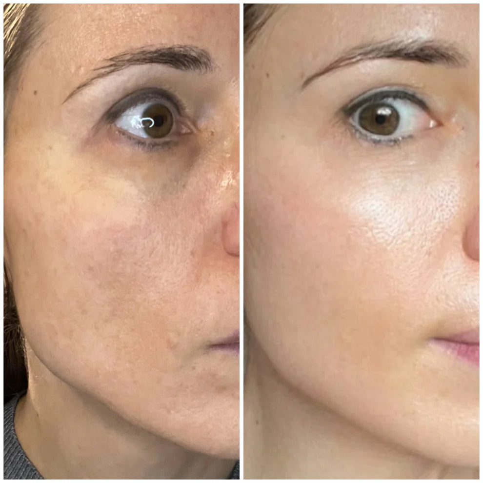 ANTI-AGING Micro Infusion Treatment 1 single applicatie