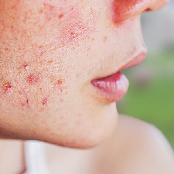 Succesverhaal: Hoe We Ernstige Acne in Slechts 3 Weken Aanpakten